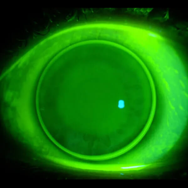 What are Specialty RGP lenses?